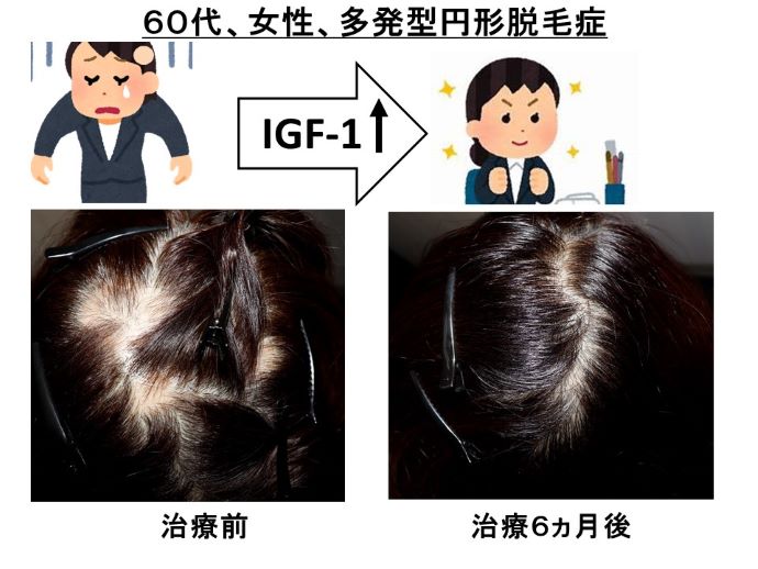 円形脱毛症　病院